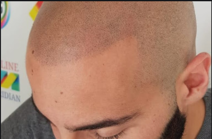 Difference Between Capillary micropigmentation lisboa And Hair Transplant