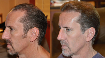 Hair restoration helps make the appearance look better